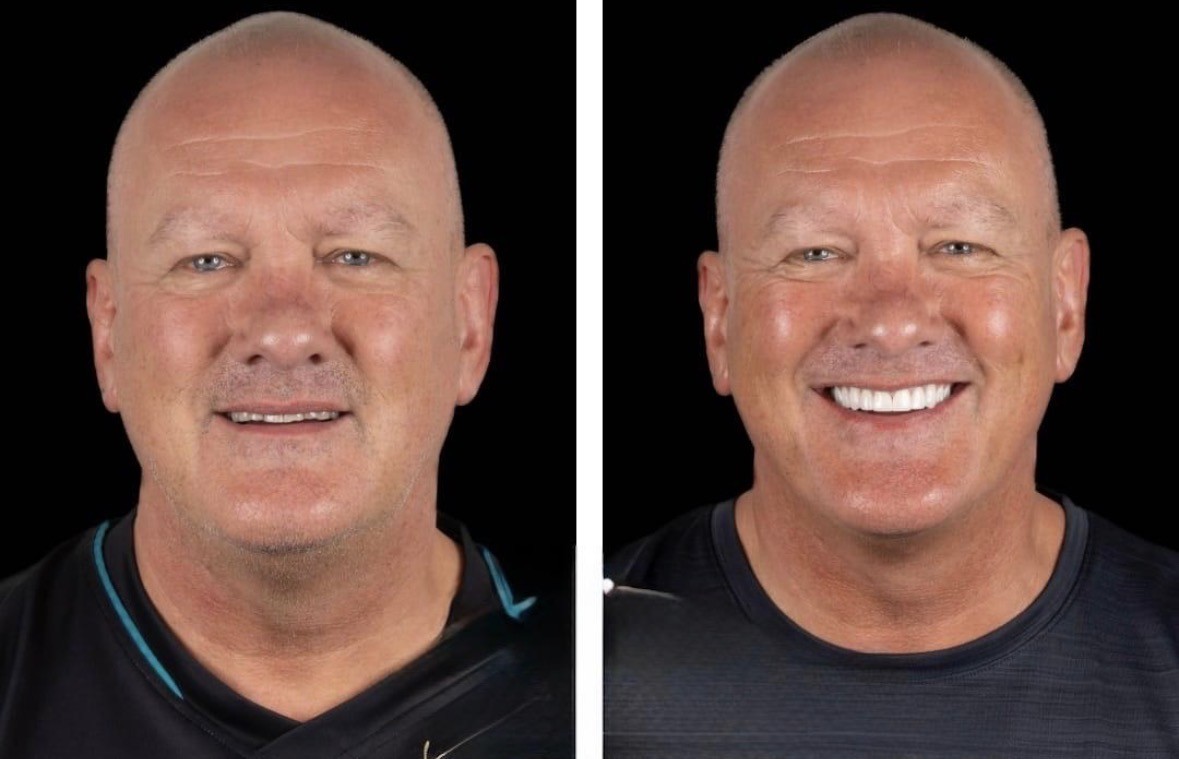 Andy, before and after treatment